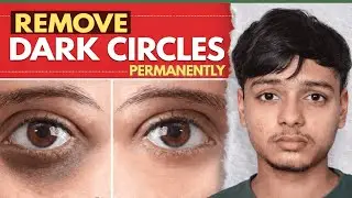 How to Fix Dark Circles Permanently on Face | Real Solution