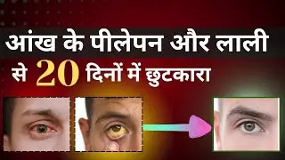 Aakho ko safed rakhne ka Tareeka  । how to cure yellow eye and red Eye