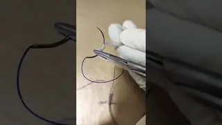 Modified Kessler's technique for tendon repair