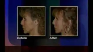 Pearl Laser & Dr. Huang on CBS in Portland, Oregon