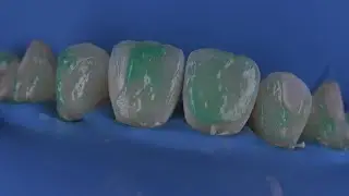 Icon resin infiltration 😁