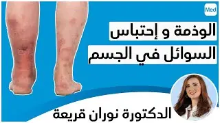 الوذمة و إحتباس السوائل في الجسم | الدكتورة نوران قريعة