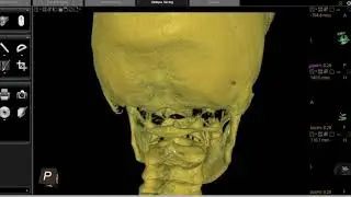 HUGE UPPER NECK MISALIGNMENT CONTRIBUTING TO MANY NUEROLOGICAL ISSUES!!