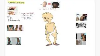 Rickets 2