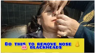Do this to remove nose 😭🐽 ब्लैकहेड्स /Best Blackhead Removal Techniques That ACTUALLY Work!