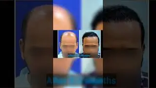 FUE Hair Transplant for High Grade Baldness: Nuleaf Hair Transplant Centre, Pune