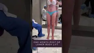 Lower Body Lift - 1 Month Post Op + Before & After