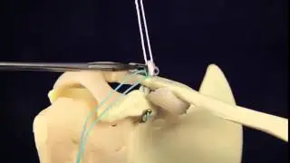 AC Joint Surgery Original technique