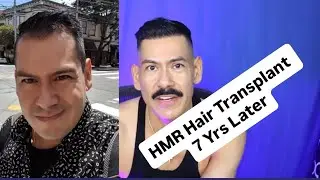 HMR Tijuana Hair Transplant Results After 7 Years