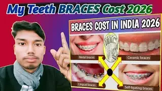 My Teeth Braces Cost ?? ! Braces Types and Cost in india in details discussion 2026