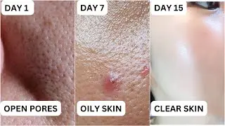 Large Open Pores, Oily Skin ಹೋಗಿ ಸ್ಮೂತ್ ಸ್ಕಿನ್ಗೆ ಮನೆ ಮದ್ದು | Open Pores Home Remedy In Kannada