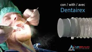 Aspirazione Aerosol Dentale  - Dental Aerosol Extraction and Filtration with Dentairex