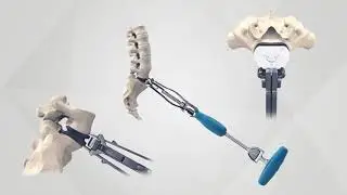 Lumbar Disc Replacement: LP ESP Surgical Technique from YouTube