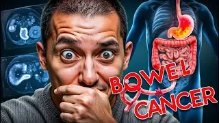 Bowel Cancer: 8 Symptoms That Require Urgent Investigation &ndash; Feeling of Incomplete Emptying!