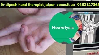 Post operative neurolysis physiotherapy #finger #muscle wasting #pain#buring#claw hand#physio #ruhs