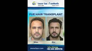 FUE Hair Transplant by Dr. Zulfiqar H. Tunio FRCS Glasgow UK