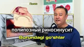 Burundagi Go'sht ya'ni полипозный риносинусит |#полипы  #lor #лорврач
