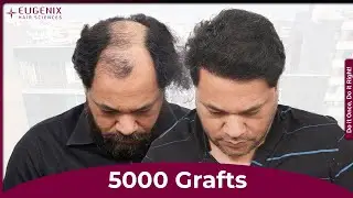 Hair Transplant in Bengaluru: Best Results & Cost of Hair Transplant in Bengaluru