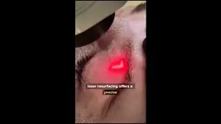 How Fractional Laser Resurfacing Improves Uneven Skin Texture
