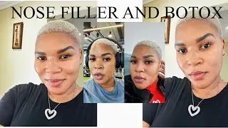 I BOUGHT A NEW FACE! Getting Filler and Botox (Nose Job & Smile lines + brow lift + forehead lift)