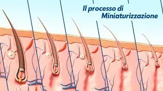 Alopecia Androgenetica: il processo di Miniaturizzazione