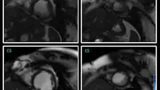 MRI Cardiac Arrythmia – Compressed Sensing (CS) @ Siemens 1.5T Aera