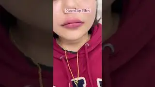 Russian Lip Filler Tenting Technique by Dr. Muskan Tyagi | Dermalyn Aesthetics | Permanent Makeup |