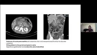 &ldquo;Thiopurines in the management of IBD
