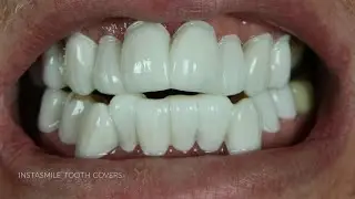 Не дайте себя обмануть Instasmile! Посмотрите это интервью с реальным клиентом!