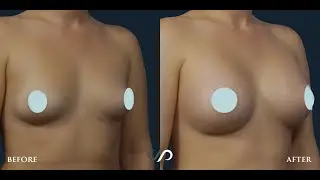 #3 Rapid Recovery Breast Augmentation with Results  | Dr. David Stoker