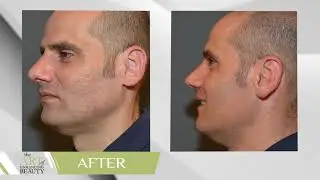 RHINOPLASTY