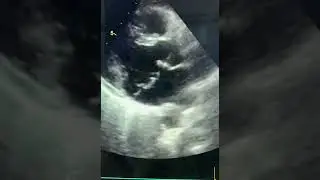Mitral Annular Disjunction on echo MAD | Bi-leaflet mitral valve prolapse | MVP echo | Barlow&rsquo;s synd