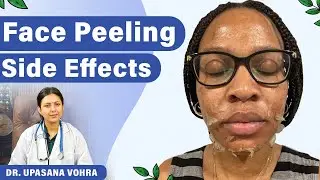 Peeling Side Effects On Skin | Chemical Peeling Ke Side Effects | Upasana Ki Duniya