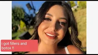 Got fillers and botox  !! Gone bad ?