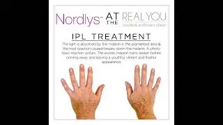Nordlys IPL Hands IPL Male - Instagram Clip - Real You Clinic