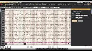 Photic Stimulation - Arc 2.2