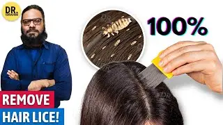 100% Hair Lice Removal | Sar Ki Juon Ka Ilaj | Urdu | Dr. Ibrahim