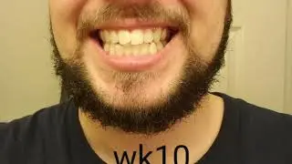 6 month mail order teeth straightening progress - smile direct club - do not recommend.