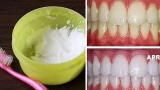 Comment avoir des dents blanches naturellement ?