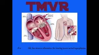 Transcatheter Mitral Valve Replacement  (TMVR) TTE/3D
