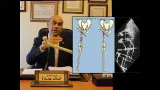 أ.د خالد عمارة  - علاج تشوهات مفصل الفخذ pelvic support osteotomy