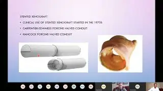 PA VSD MAPCAs in ACHD - Sreevathsa Kadaba