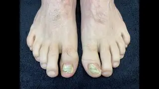 Cured Nail Fungus in Athlete (Before and After)