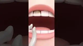Sugar bug attack!! Ang Ang has a bad tooth🦷 | Dentist Play for Kids | #PullTooth #Shorts