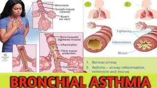 BRONCHIAL ASTHMA, What is Brochial Asthma kiya hai ?