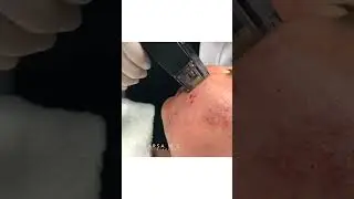 Before and After Morpheus8 for Acne | Dr.  Kami Parsa, M.D.