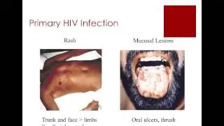 HIV for Primary Care Physicians