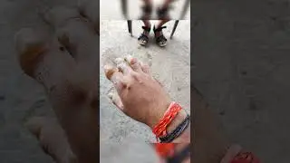 firecrackers accident #handburn #firecracker #anar #blast #burst #accidentnews