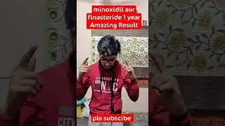 My 1 year Morr f5% minoxidil finasteride Amazing Result. stop receding hairline #shorts