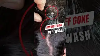 Best Anti Dandruff Shampoo